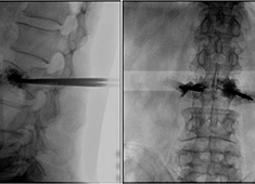C臂機(jī)在打骨水泥時(shí)是怎么使用的(PKP手術(shù)記錄)