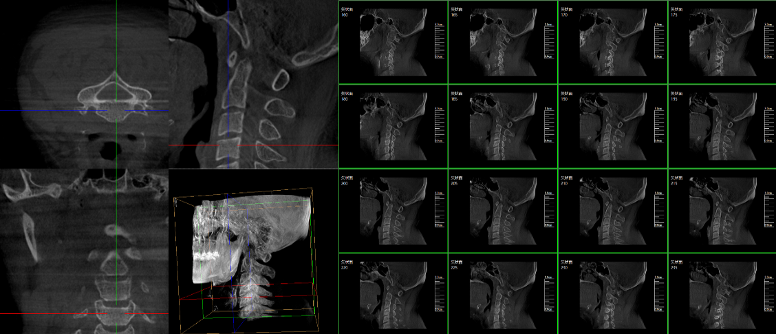 PLX7500三維c型臂脊柱外科臨床應用圖像 PLX7500三維c型臂脊柱外科臨床應用圖像