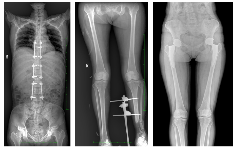 大視野平板動態(tài)DR臨床影像 大視野平板動態(tài)DR臨床影像