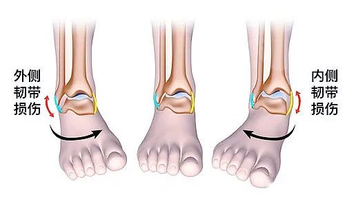 【醫療科普】之為什么說踝關節骨折手術復雜? 【醫療科普】之為什么說踝關節骨折手術復雜?