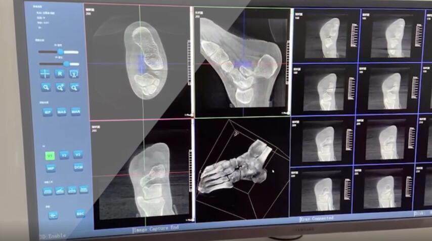 【醫(yī)療科普】:踝關(guān)節(jié)三維掃描 【醫(yī)療科普】:踝關(guān)節(jié)三維掃描