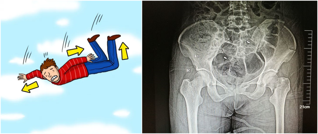 【醫療科普】:外傷性骨折影像 【醫療科普】:外傷性骨折影像