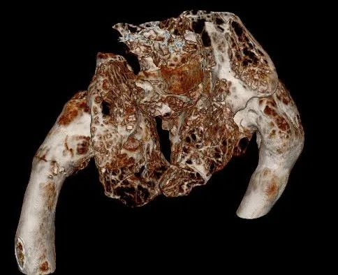 【醫療科普】:病理性骨折影像 【醫療科普】:病理性骨折影像