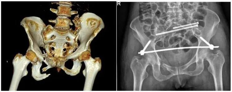 【醫療科普】:不穩定性骨折影像 【醫療科普】:不穩定性骨折影像