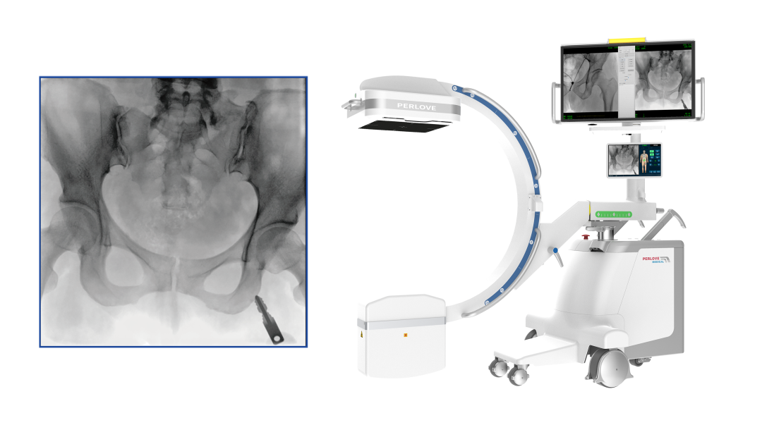 【醫療科普】:大尺寸平板C形臂提供更多圖像細節 【醫療科普】:大尺寸平板C形臂提供更多圖像細節