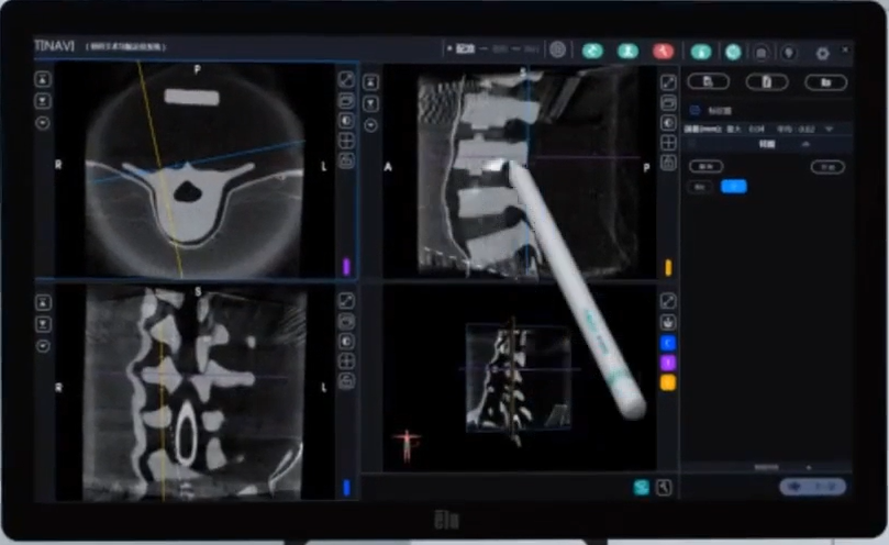 骨科手術機器人數據分析 骨科手術機器人數據分析