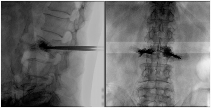 一體式移動(dòng)C臂腰椎影像 一體式移動(dòng)C臂腰椎影像