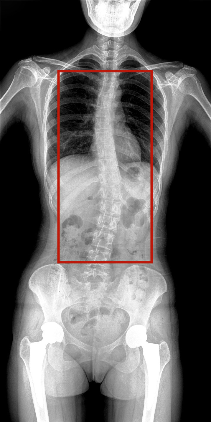 全脊柱動態DR圖像 全脊柱動態DR圖像