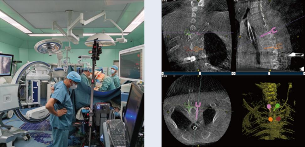 術中三維C形臂影像在脊柱導航機器人系統中的應用 術中三維C形臂影像在脊柱導航機器人系統中的應用