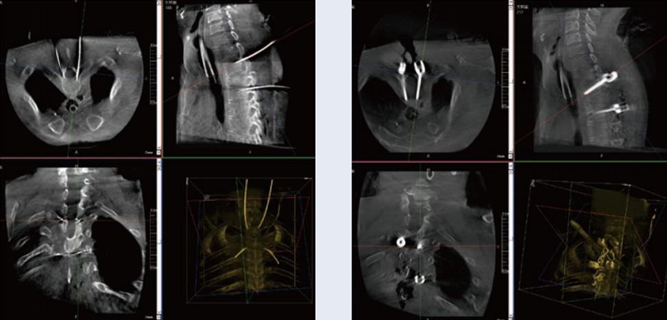 術中三維C形臂影像在脊柱導航機器人系統中的應用 術中三維C形臂影像在脊柱導航機器人系統中的應用