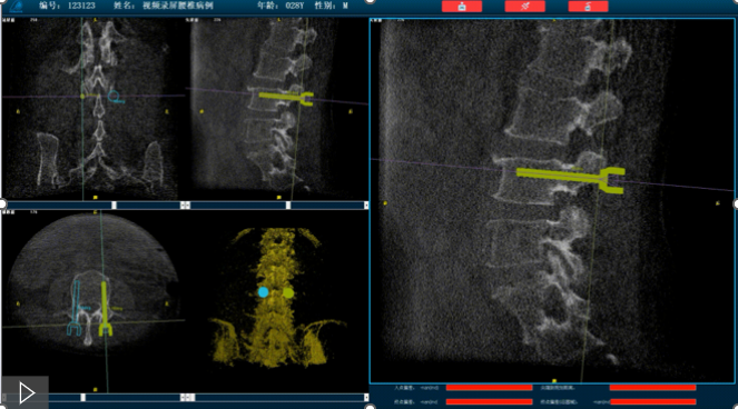 骨科機(jī)器人路線規(guī)劃 骨科機(jī)器人路線規(guī)劃