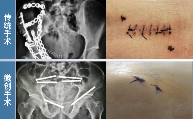 骨科機(jī)器人微創(chuàng)手術(shù) 骨科機(jī)器人微創(chuàng)手術(shù)