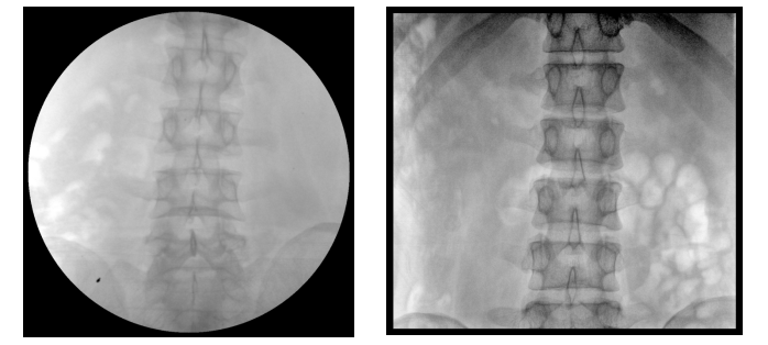 移動(dòng)式平板C形臂X射線機(jī)腰椎圖像