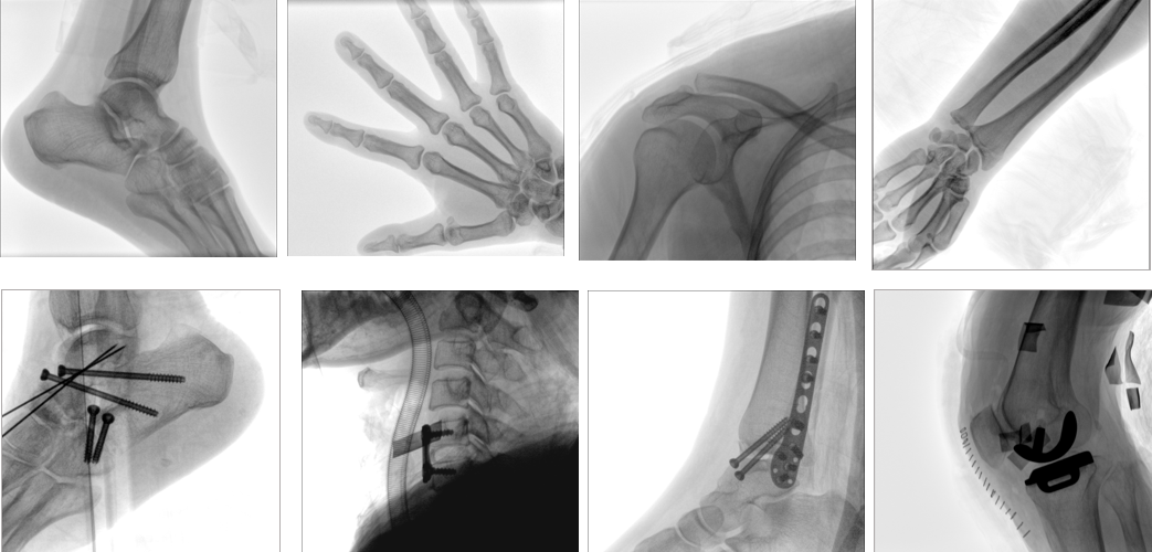 移動(dòng)式平板C形臂X射線機(jī)臨床影像